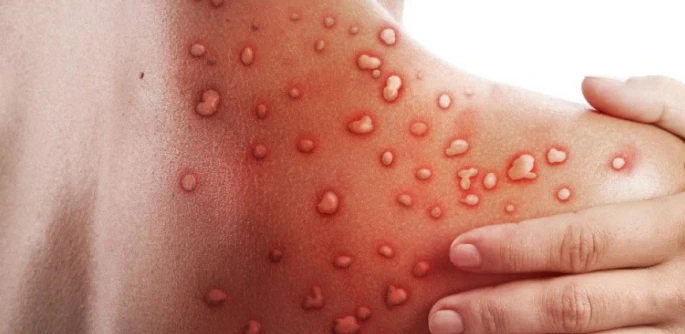 Sakarya’da Maymun Çiçeği Şüphesi: İl Sağlık Müdürlüğü’nden Açıklama Geldi