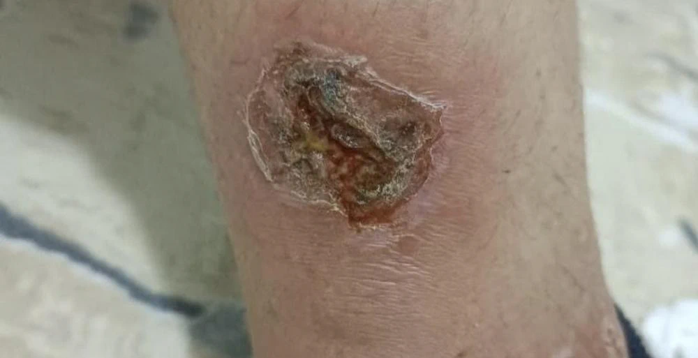 Hatay'da "Kamikaze Sivrisinek" Tehlikesi: Vatandaşlar Çözüm Bekliyor